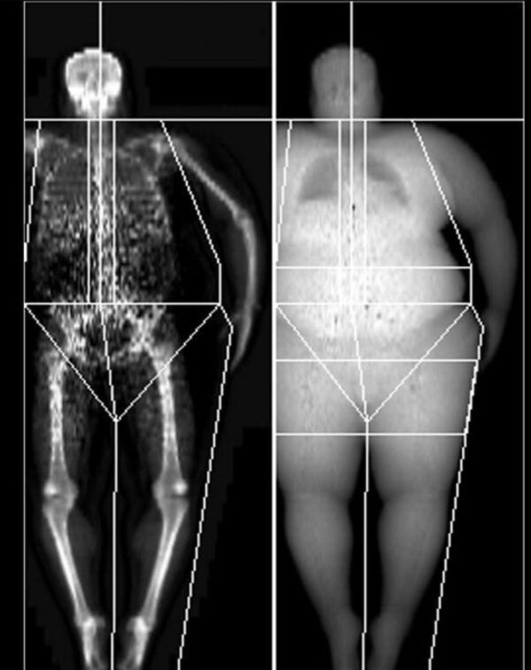 ¿Cuál es el factor predictivo mas preciso de fractura de cadera?
