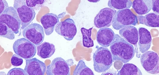 ¿Qué es la leucemia mieloide aguda?