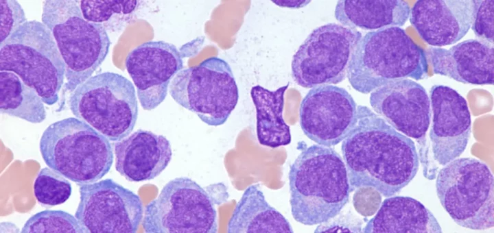 ¿Qué es la leucemia mieloide aguda?