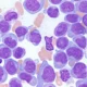 ¿Qué es la leucemia mieloide aguda?