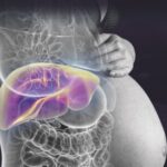 Hígado graso agudo del embarazo