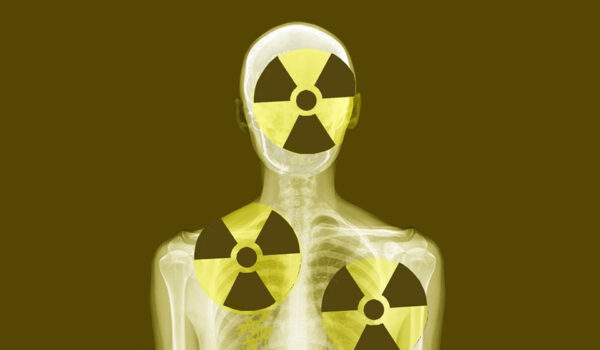 Carcinogenia por la radiación