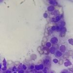 Anemia aplásica inducida por infecciones