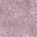 ¿Qué es la Agranulocitosis?