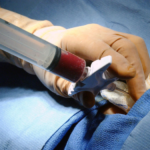 Estados aplásicos de la médula ósea