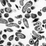 Manifestaciones clínicas de la fiebre Q aguda