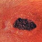 Manifestaciones del carbunco