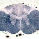 ¿Qué es Tabes dorsal?