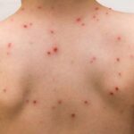 Rebrote de la viruela símica (Mpox)