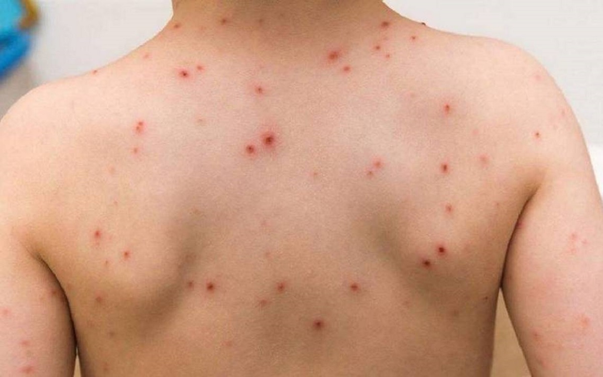 Rebrote de la viruela símica (Mpox)