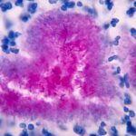 ¿Qué causa la nocardiosis?