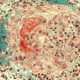 poliangitis microscópica