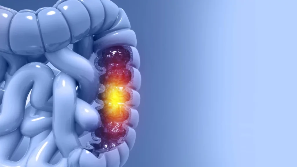 Tipos de neoplasias de intestino grueso