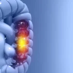 Tipos de neoplasias de intestino grueso