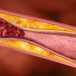 Rotura de placa ateroesclerótica