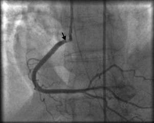 Arteriografía en paciente con angina de Prinzmetal