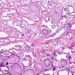 Patología de la hiperplasia benigna de próstata