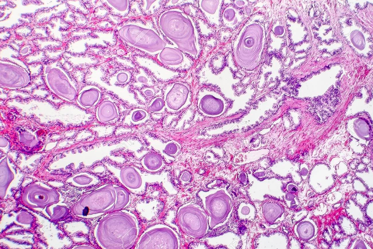 Patología de la hiperplasia benigna de próstata