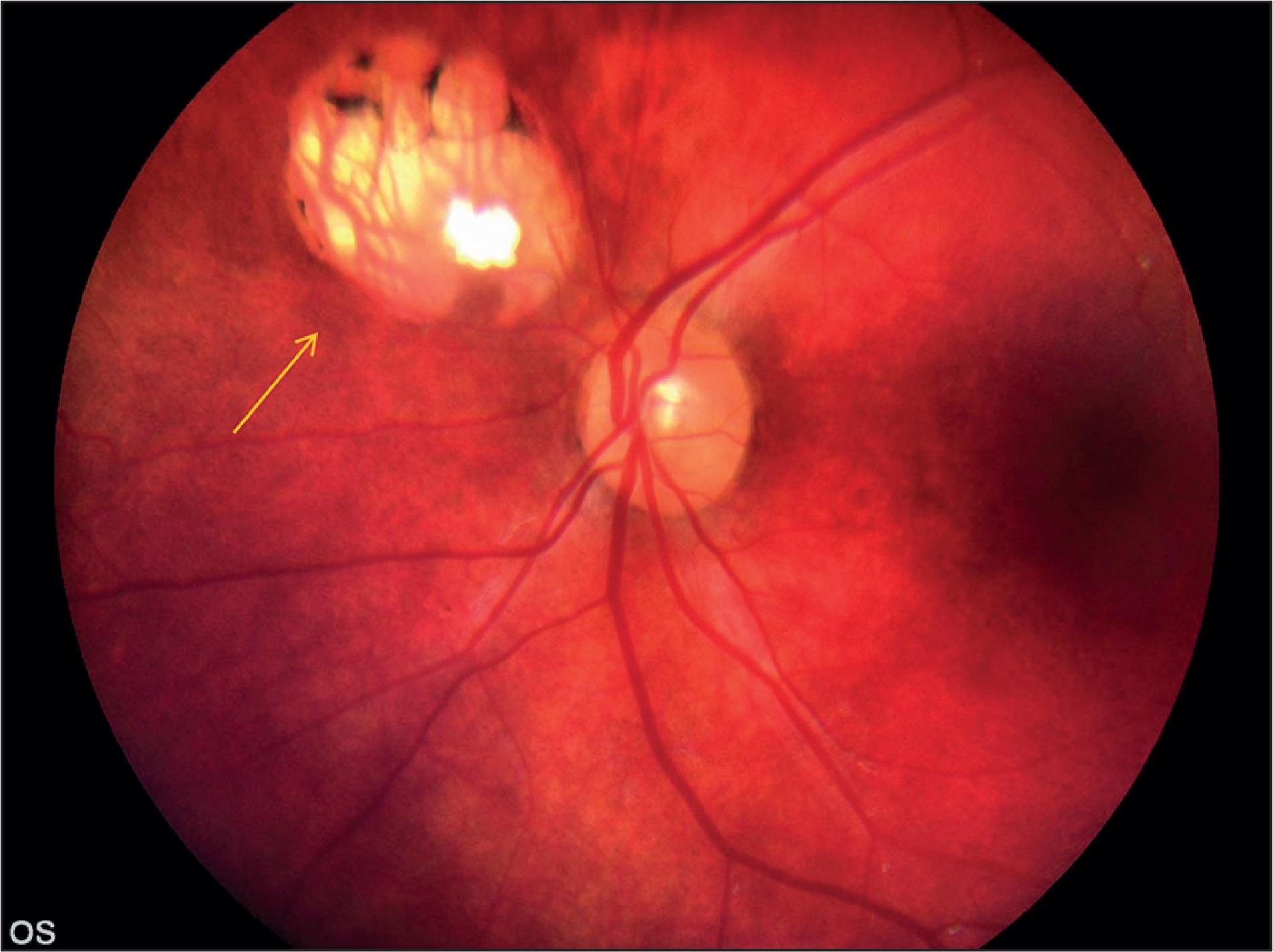 Toxoplasmosis ocular en lactantes