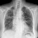 Tratamiento de la neumonitis por hipersensibilidad