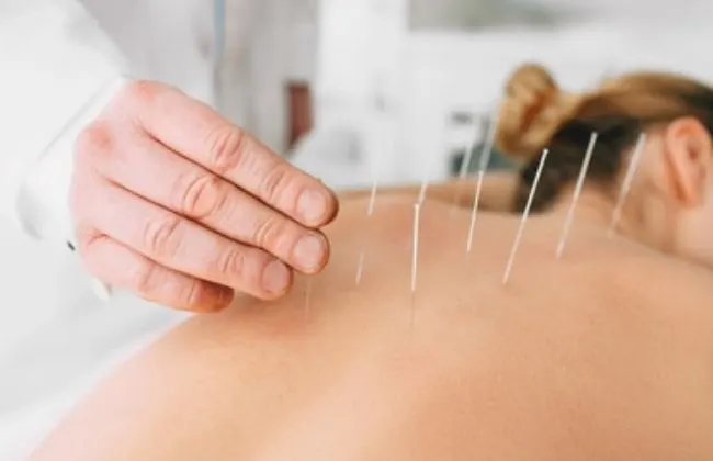 Beneficios reales de la acupuntura para la salud