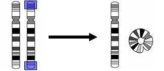 Anomalías cromosómicas: cromosoma anular