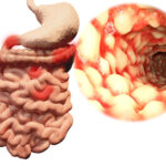 Factores de riesgo en la enfermedad inflamatoria intestinal