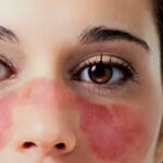 ¿En quienes es mas probable el lupus eritematoso sistémico?