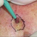 Tratamiento de carcinomas de células basales morfeiformes