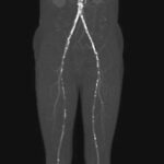 Tratamiento integral de la enfermedad aortoiliaca