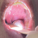 ¿Que es la infección periamigdalina?