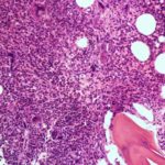 ¿Qué es la mielofibrosis primaria?