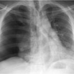 Recurrencia del neumotórax