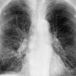 ¿Qué es la enfermedad pulmonar intersticial?