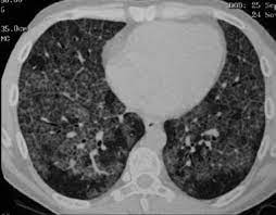 ¿Qué es la enfermedad pulmonar intersticial?
