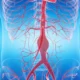 Aneurisma de la aorta