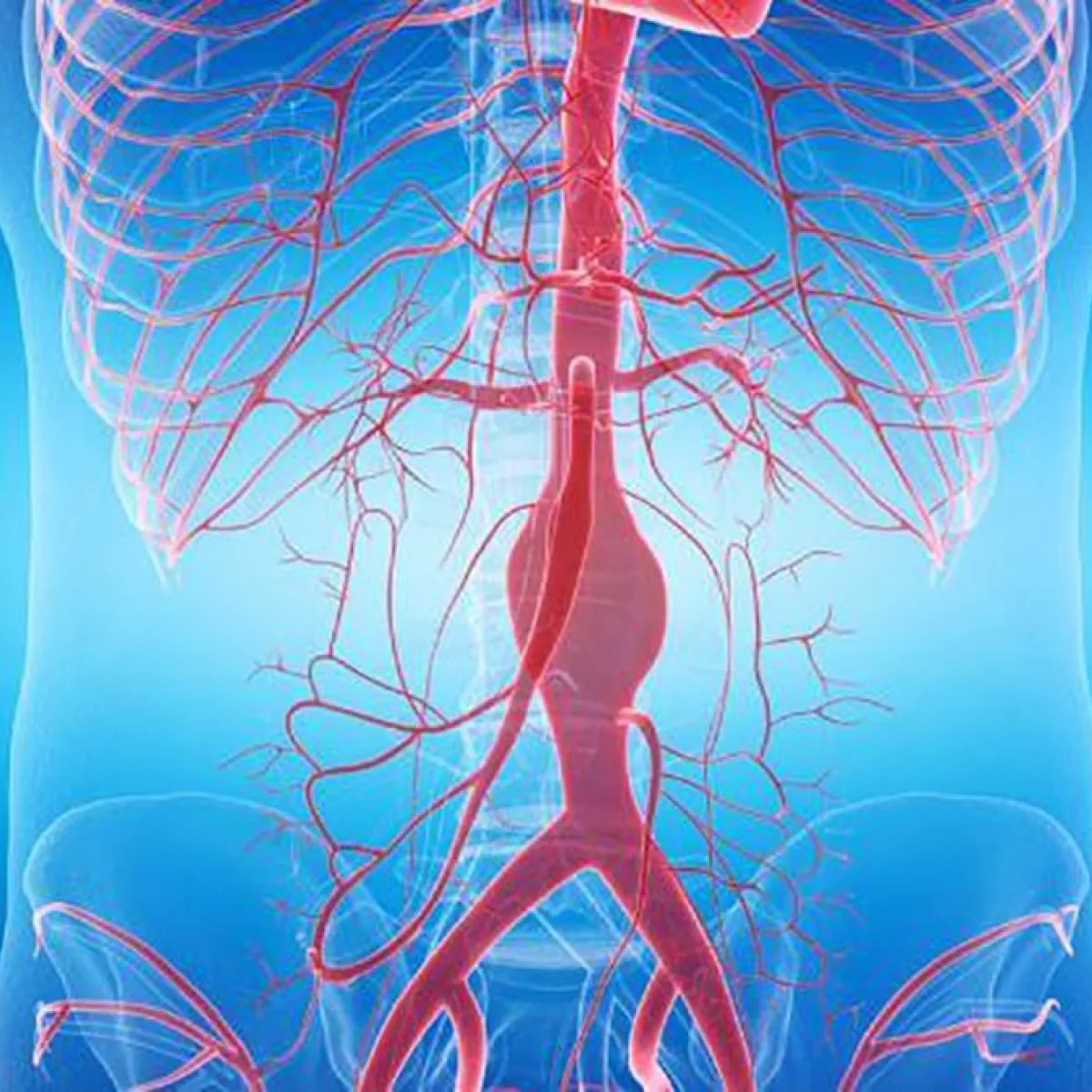 ¿Qué es un aneurisma de la aorta?