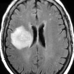 ¿Qué microorganismos causan comúnmente un absceso cerebral?