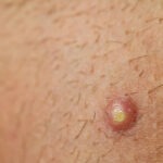 ¿Cuáles son las causas del forúnculo?