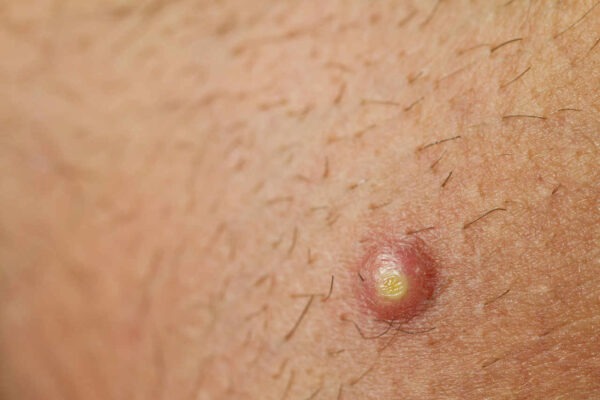 ¿Cuáles son las causas del forúnculo?