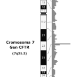 ¿Qué causa la fibrosis quística?