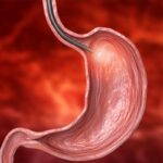 Causas de hemorragia gastrointestinal alta aguda