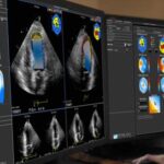 Ecocardiografía de estrés en pacientes con dolor torácico