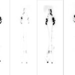 Estudio de pacientes con edema de miembros inferiores