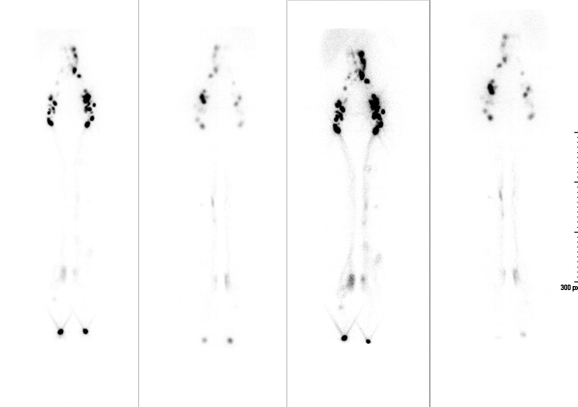 Estudio de pacientes con edema de miembros inferiores