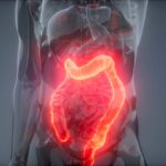 ¿Qué es el síndrome de colon irritable?