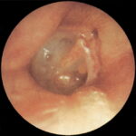 Otitis media crónica