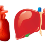 Hepatitis isquémica o hipóxica