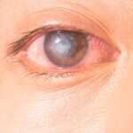 ¿Qué es la queratitis bacteriana?