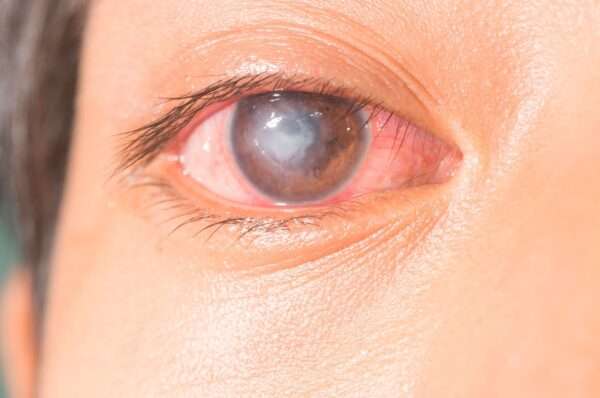 ¿Qué es la queratitis bacteriana?